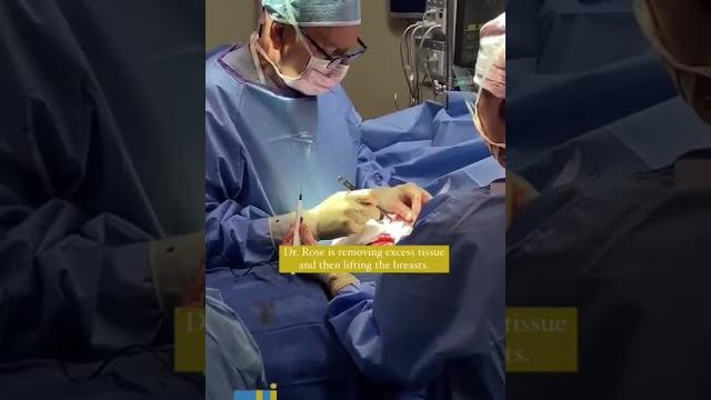 Breast reduction from an hhh (triple-h) cup to a full c cup - dr. franklin rose houston, texas Breast reduction from an hhh (triple-h) cup to a full c cup - dr. franklin rose houston, texas