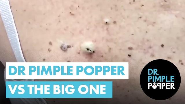 Dr pimple popper vs the big one Dr pimple popper vs the big one