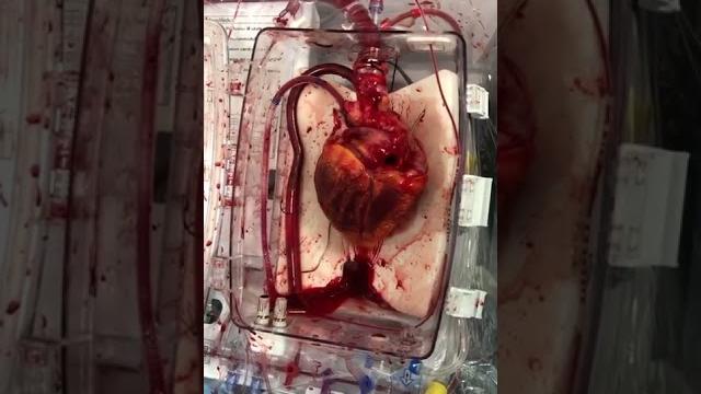 Donation after circulatory death (dcd) heart transplant Donation after circulatory death (dcd) heart transplant