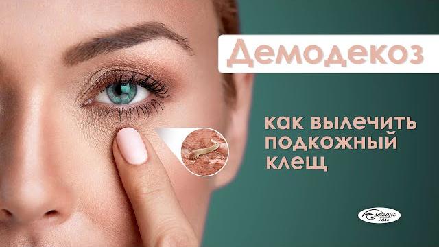 Демодекоз: как распознать и избавиться от клеща Демодекоз: как распознать и избавиться от клеща