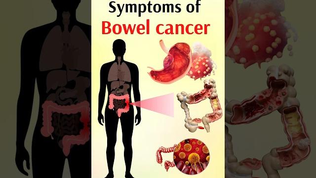 Symptoms of bowel cancer #shorts Symptoms of bowel cancer #shorts