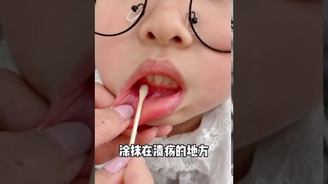 口腔潰瘍好難受怎麼辦?一招搞定馬上就不疼啦 口腔潰瘍好難受怎麼辦?一招搞定馬上就不疼啦
