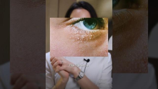 «жировики» на лице ! что с ними делать ? «жировики» на лице ! что с ними делать ?