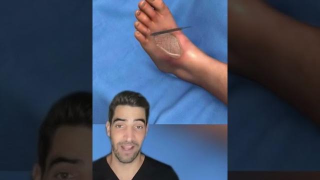 Skin graft Skin graft