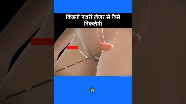 Kidney stones treatment | rirs | retrograde intrarenal surgery | laser kidney stone removal # shorts Kidney stones treatment | rirs | retrograde intrarenal surgery | laser kidney stone removal # shorts