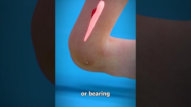 Sprained ankle (explained) Sprained ankle (explained)