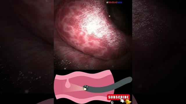 Coloscopy | colon polyp resection | polypectomy Coloscopy | colon polyp resection | polypectomy