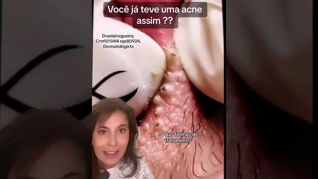 Isso é acne Isso é acne