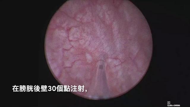 肉毒桿菌毒素注射 肉毒桿菌毒素注射