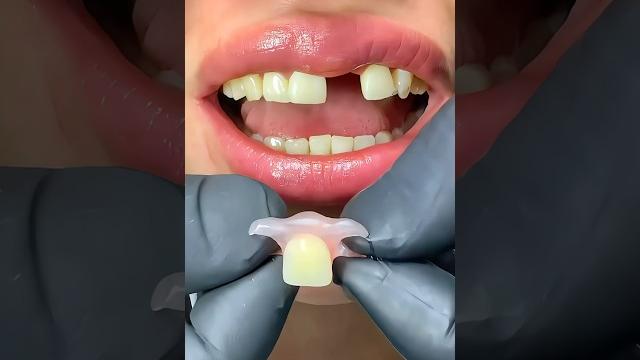 Solution with flexible dental prosthesis of 1,2,3 tooth #mrdent #dentist #smile #protesisdental Solution with flexible dental prosthesis of 1,2,3 tooth #mrdent #dentist #smile #protesisdental