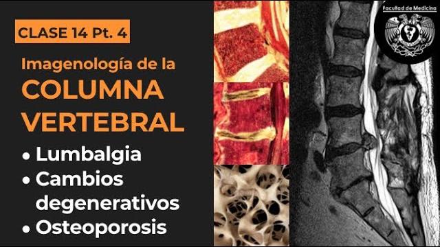 14.4 - imagenología de los cambios degenerativos de la columna vertebral y osteoporosis 14.4 - imagenología de los cambios degenerativos de la columna vertebral y osteoporosis