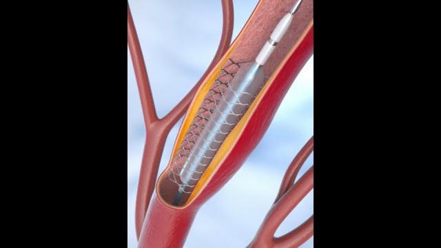 Coronary angioplasty and stent insertion #animation #shorts #anatomy #science #asmr Coronary angioplasty and stent insertion #animation #shorts #anatomy #science #asmr