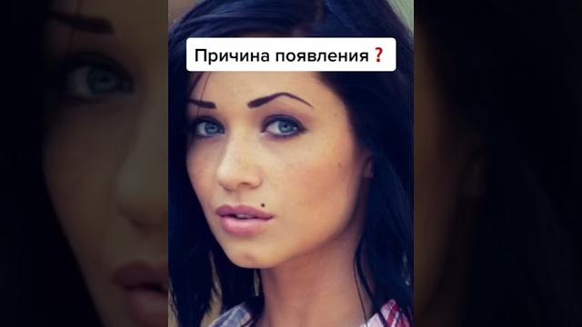 Почему появляются родинки#shorts Почему появляются родинки#shorts