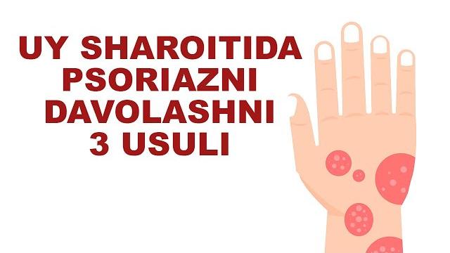 Psoriazni uy sharoitida davolash 3 usuli Psoriazni uy sharoitida davolash 3 usuli