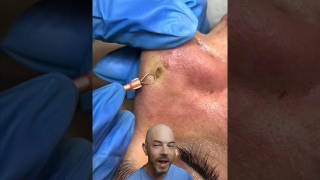 You won’t believe this giant pimple extraction! (credit:pimple.extractionn on tt)#satisfying #viral You won’t believe this giant pimple extraction! (credit:pimple.extractionn on tt)#satisfying #viral