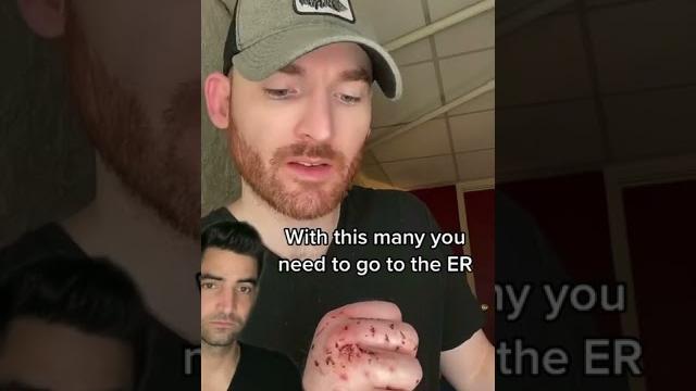 Cat bite and what to do Cat bite and what to do