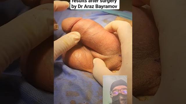 Penile enlargement surgery results after surgery by dr araz bayramov #andrologist #urologist #draraz Penile enlargement surgery results after surgery by dr araz bayramov #andrologist #urologist #draraz