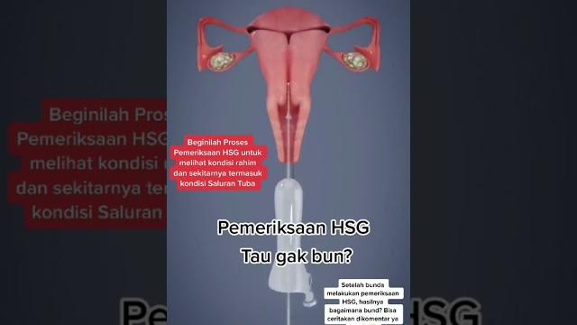 Seperti inilah pemeriksaan hsg (histerosalpingografi) Seperti inilah pemeriksaan hsg (histerosalpingografi)