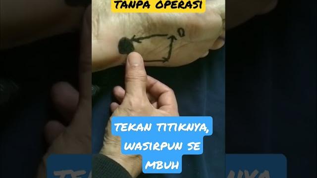 Tanpa obat ,cukup tekan titiknya. wasir sembuh #wasirsembuh #shorts #shortsvidio #lukiafandi Tanpa obat ,cukup tekan titiknya. wasir sembuh #wasirsembuh #shorts #shortsvidio #lukiafandi