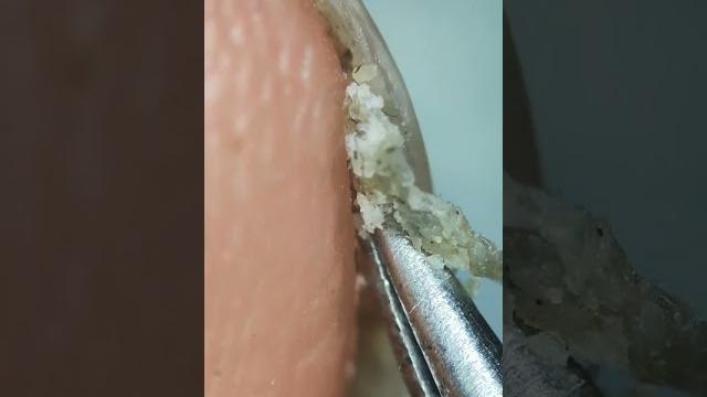Грязь с под ногтей под микроскопом Грязь с под ногтей под микроскопом