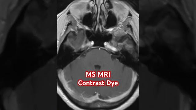 Ms mri contrast dye Ms mri contrast dye