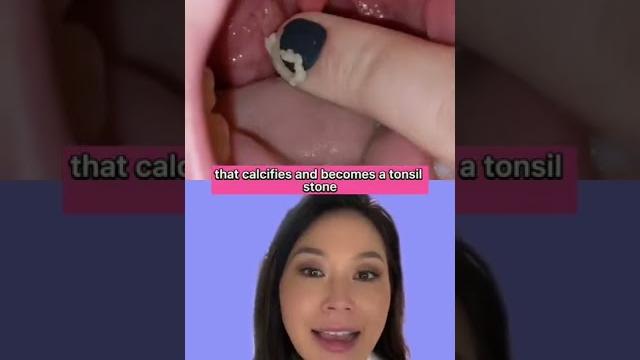 Whoa dentist explains how tonsil stones are made #tonsilstones Whoa dentist explains how tonsil stones are made #tonsilstones