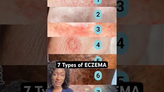7 eczema types: how to tell which one you have? 7 eczema types: how to tell which one you have?