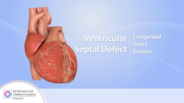 Heart conditions – ventricular septal defect (vsd) Heart conditions – ventricular septal defect (vsd)