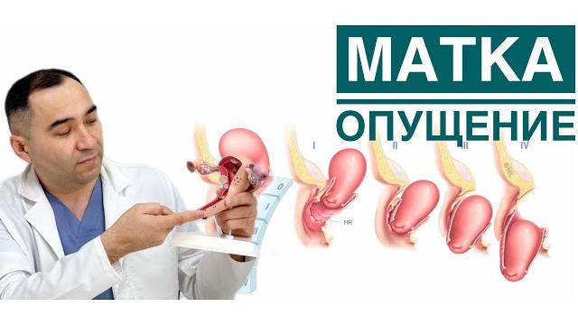 Жатырдың төмен түсуі.әйелдерде көп кездесетін ауру.емделу жолдары қандай?доктор ардақ аязбеков🩺 Жатырдың төмен түсуі.әйелдерде көп кездесетін ауру.емделу жолдары қандай?доктор ардақ аязбеков🩺