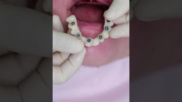 Dental implant’s all on 4 #shorts #smile #impossible #dentist #best #new #beautiful #shortvideo Dental implant’s all on 4 #shorts #smile #impossible #dentist #best #new #beautiful #shortvideo