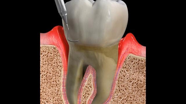 Periodontal cleaning Periodontal cleaning