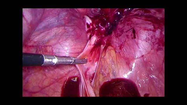 Result of complete laparoscopic resection on die with bilateral endometrioma, 10 years pot op Result of complete laparoscopic resection on die with bilateral endometrioma, 10 years pot op
