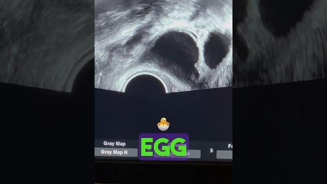 Beautiful egg in follicle @drsuniljindal #best ivf doctor Beautiful egg in follicle @drsuniljindal #best ivf doctor