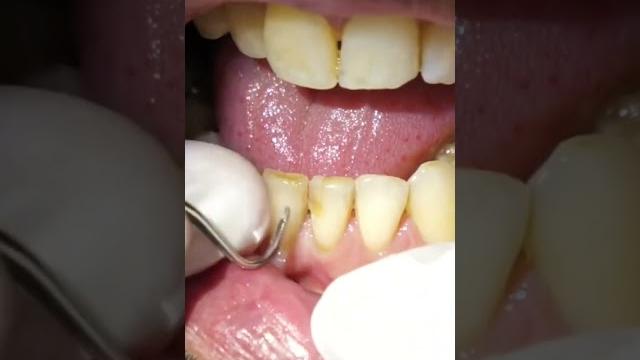 Smoker’s teeth dental cleaning #shorts Smoker’s teeth dental cleaning #shorts
