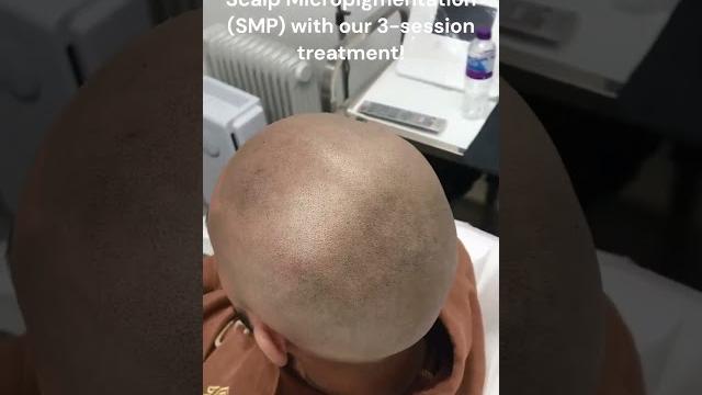 Boxed / sharp hairline restoration with #scalpmicropigmentation #smp #hairlinetattoo #shorts Boxed / sharp hairline restoration with #scalpmicropigmentation #smp #hairlinetattoo #shorts