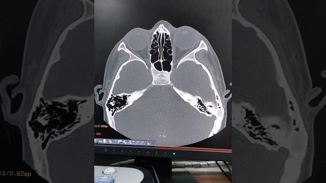 Ct scan of pns.#viral #medical #shortfeeds . Ct scan of pns.#viral #medical #shortfeeds .