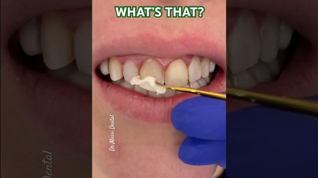 What is that stick on my tooth? What is that stick on my tooth?