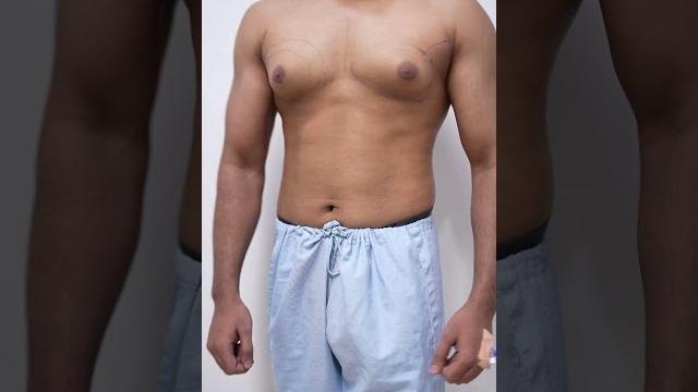 How to get rid of man boobs permanently #shorts How to get rid of man boobs permanently #shorts