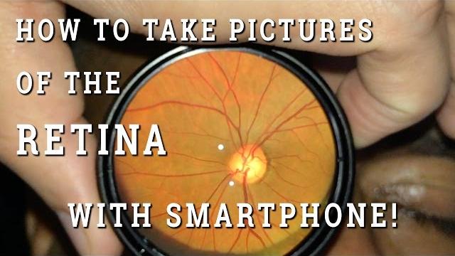 Retinal photography with smartphone Retinal photography with smartphone