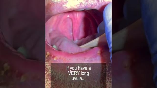 Long uvula and snoring #shorts @fauquierent Long uvula and snoring #shorts @fauquierent