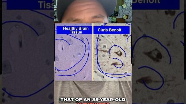 Doctors say that chris benoit’s brain resembled that of an 85 year old alzheimer’s patient! #wwe Doctors say that chris benoit’s brain resembled that of an 85 year old alzheimer’s patient! #wwe