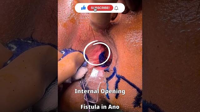 Fistula in ano ? how it looks ?? video & photos i bhagandar ? pics of fistula i images Fistula in ano ? how it looks ?? video & photos i bhagandar ? pics of fistula i images