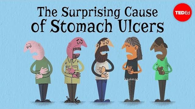 The surprising cause of stomach ulcers - rusha modi The surprising cause of stomach ulcers - rusha modi