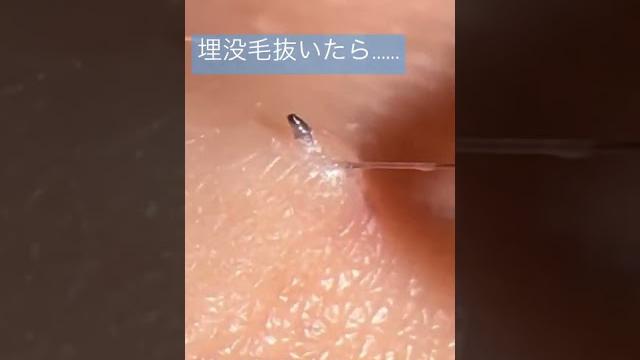 毛を抜いただけなのに 毛を抜いただけなのに