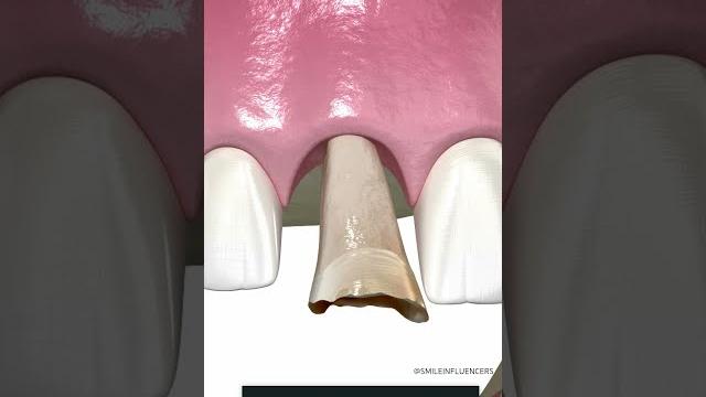 Tooth implant procedure {step by step} Tooth implant procedure {step by step}
