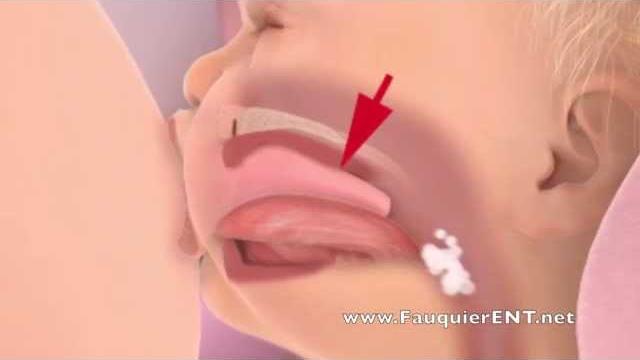 Breastfeeding problems Breastfeeding problems