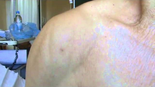 Muscle twitching and spasms | nejm Muscle twitching and spasms | nejm