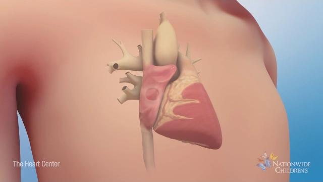 Understanding atrial septal defect (asd) Understanding atrial septal defect (asd)