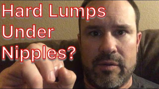 Hard lumps under nipples - adolescent males Hard lumps under nipples - adolescent males