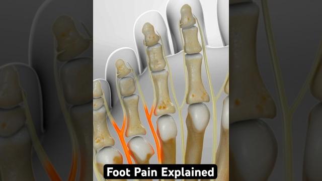 What is causing your foot pain? (3d animation) What is causing your foot pain? (3d animation)